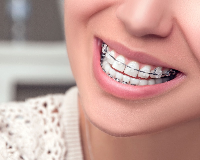 Reasons Behind the Popularity of Invisible Braces